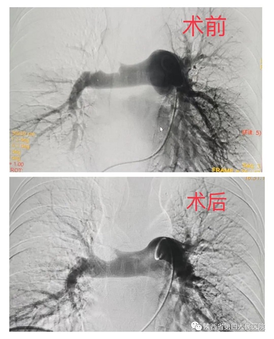 陕西省第四人民医院心血管内科成功救治危重肺栓塞患者
